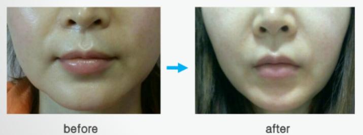 lipo lab v line before after