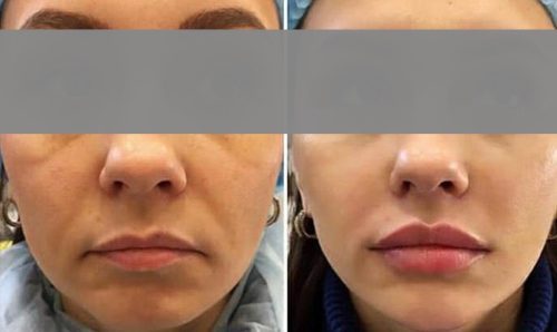 Click to view full screen Neuramis Volume Lidocaine photo review